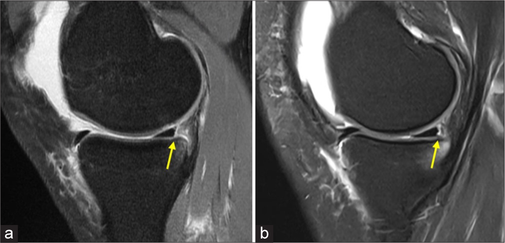 Magnetic resonance imaging (MRI) (a) sagittal view of a ramp tear in the posteromedial meniscocapsular junction and (b) posteromedial meniscus within 3 mm of the peripheral rim. The ramp tears are marked with yellow arrows. Both MRIs present with posteromedial tibial plateau bruising.