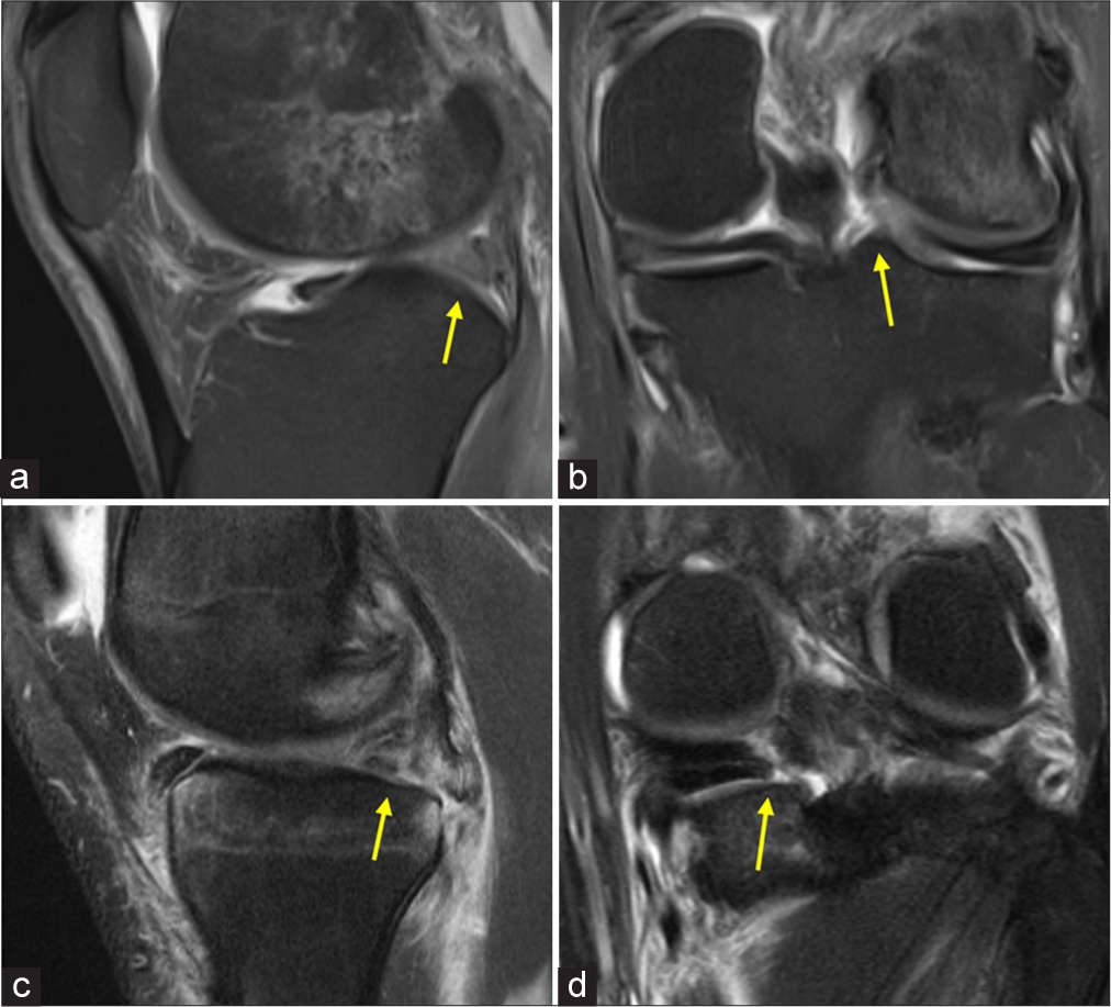 Magnetic resonance imaging of left knees with signs demonstrating evidence of (a and b) lateral and (c and d) medial posterior meniscal root tear. (a and c) Sagittal view of the left knee showing a ghost sign (yellow arrows) which is a common indicator of (a) lateral and (c) medial posterior meniscus root tear. (b and d) Coronal view of the left knee showing the (b) lateral and (d) medial posterior meniscus root tears (yellow arrows).