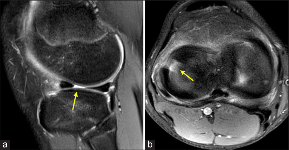 Magnetic resonance images of a complete radial tear in (a) sagittal view and (b) axial view. Radial tears typically present as a fluid filled break in the meniscus on both sagittal and axial magnetic resonance imaging views. The yellow arrows point to the location of the tears.