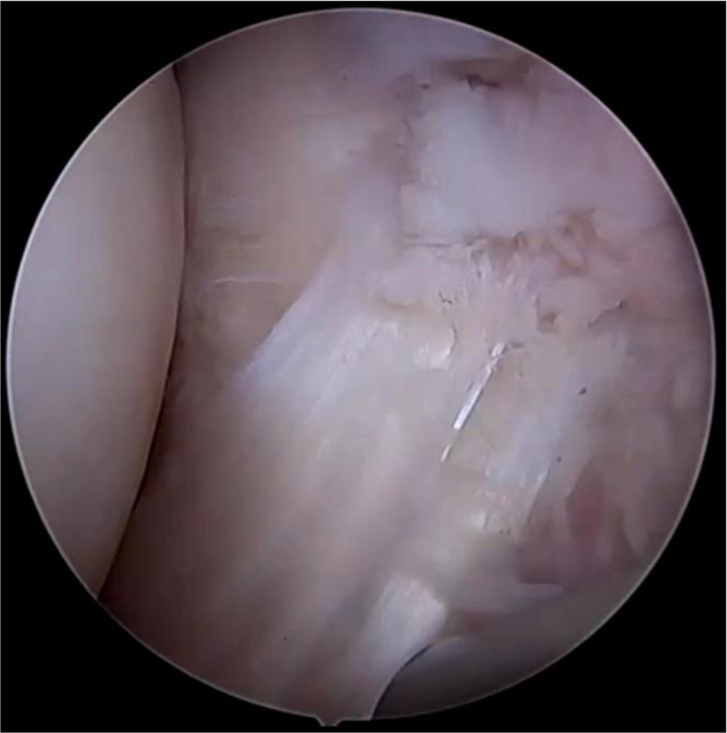 Arthroscopic view of a horizontal tear in the anterior horn of the lateral meniscus.