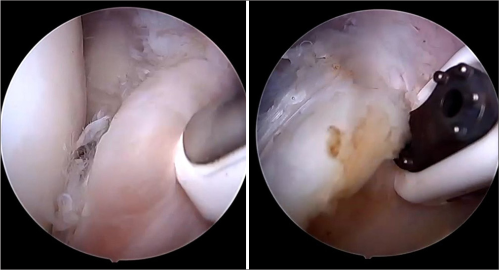 The cyst was de-bulked using arthroscopic radiofrequency system to reveal a horizontal tear in the anterior horn of the lateral meniscus.