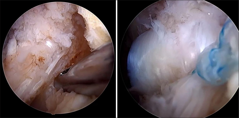 A sliding knot is placed to repair the tear to the footprint of the anterior horn of the lateral meniscus instead of the usual meniscocapsular repair.