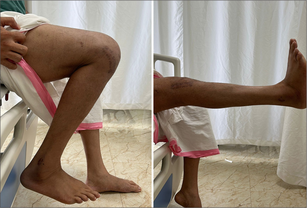 Patient’s active knee range of motion was 5-110° without any pain or instability during the follow-up.