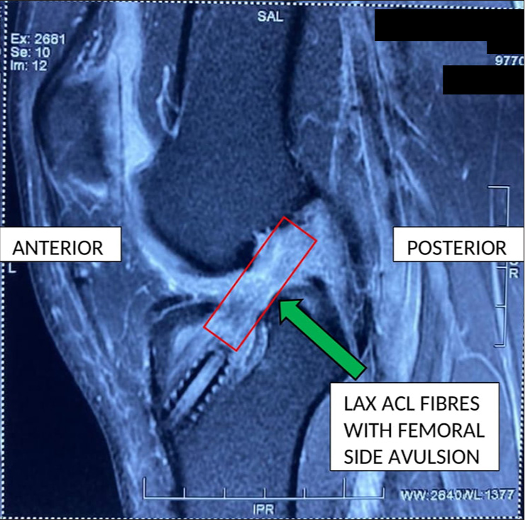 Magnetic resonance imaging scan of the right knee showing tear of femoral attachment of anterior cruciate ligament graft with (green arrow) laxity of the remaining fibers.