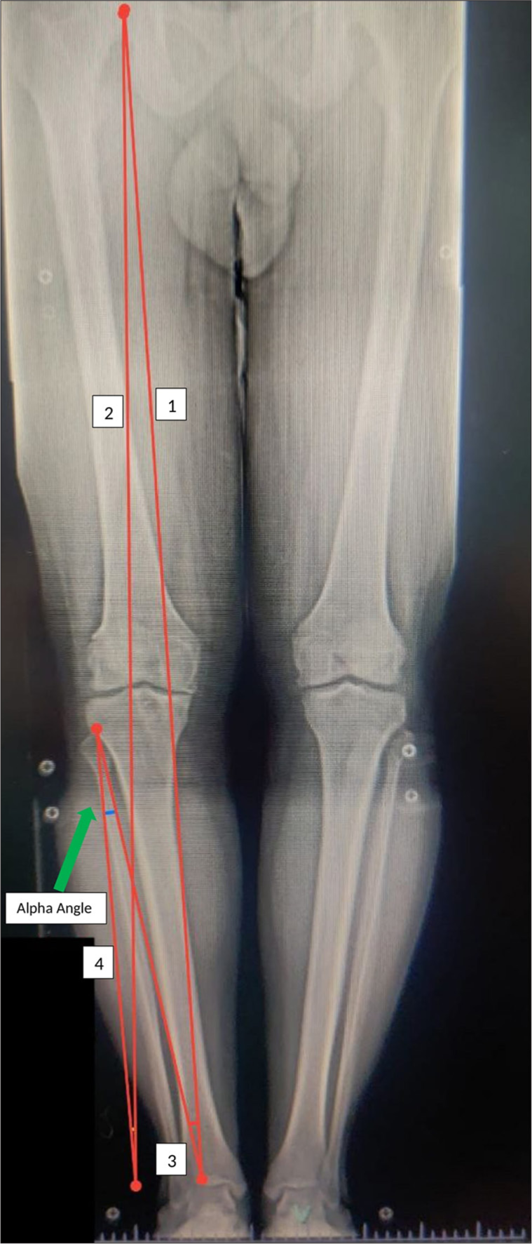 A standing scanogram Line 1 representing pre-operative mechanical axis: Line 2: Planned weight-bearing line; Angle between lines 3 and 4 represents alpha angle calculated by Miniaci’s method – 8.3° as shown by green arrow.