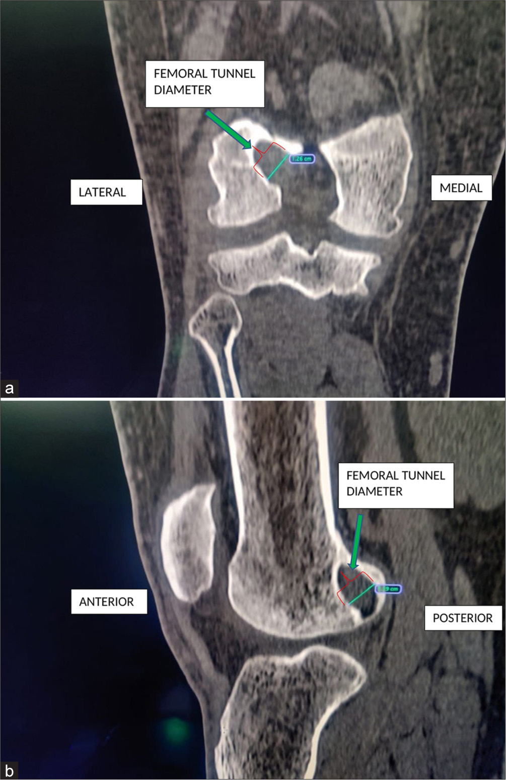 (a) Pre-operative computed tomography scan coronal section showing femoral tunnel diameter (green arrow) of 12.6 mm, (b) Pre-operative computed tomography scan sagittal section showing femoral tunnel diameter (green arrow) of 11.9 mm.