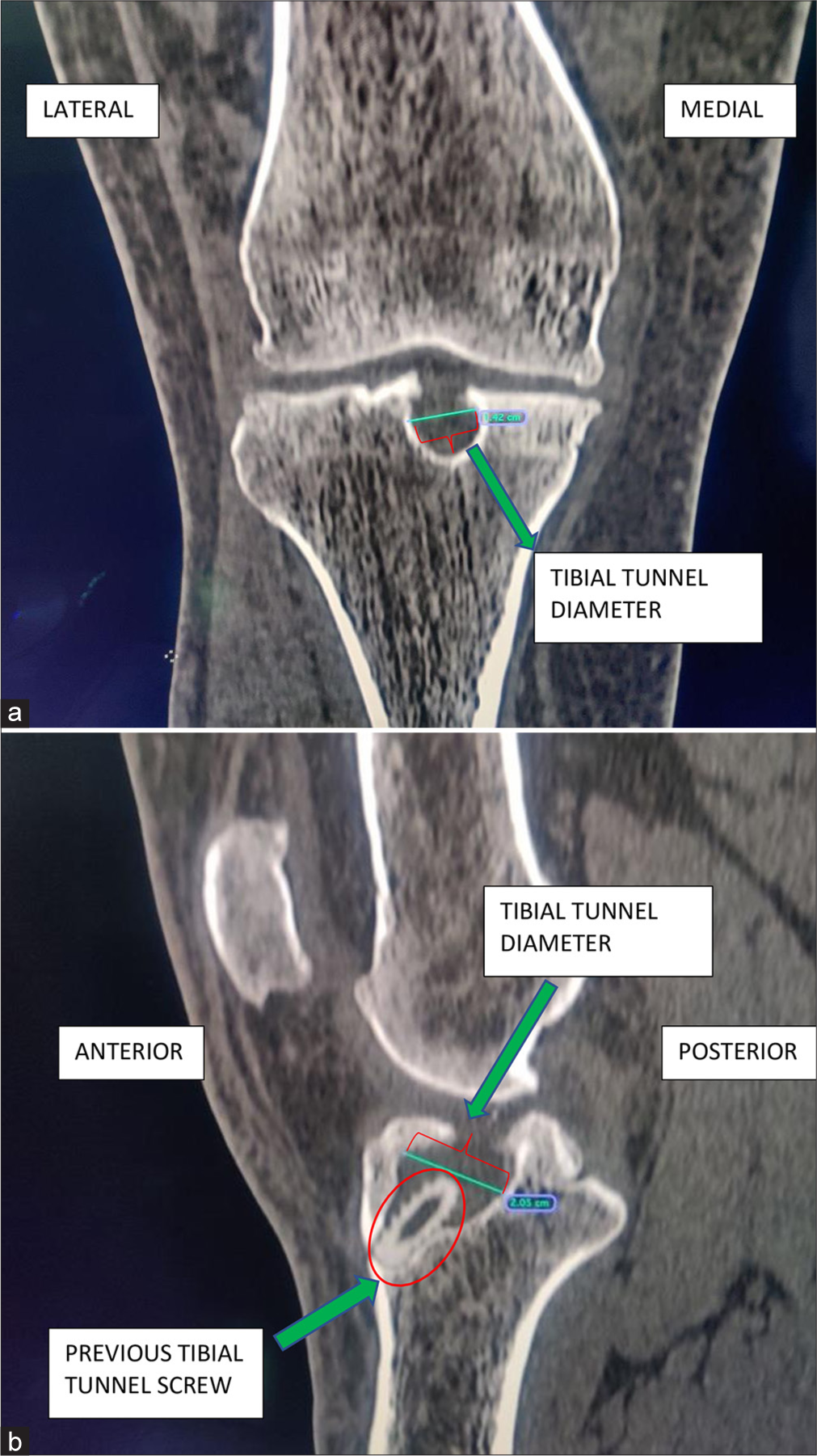 (a) Pre-operative computed tomography scan coronal section showing tibial tunnel diameter (green arrow) of 14.2 mm. (b) Pre-operative computed tomography scan sagittal section showing tibial tunnel diameter (green arrow) of 20.5 mm.