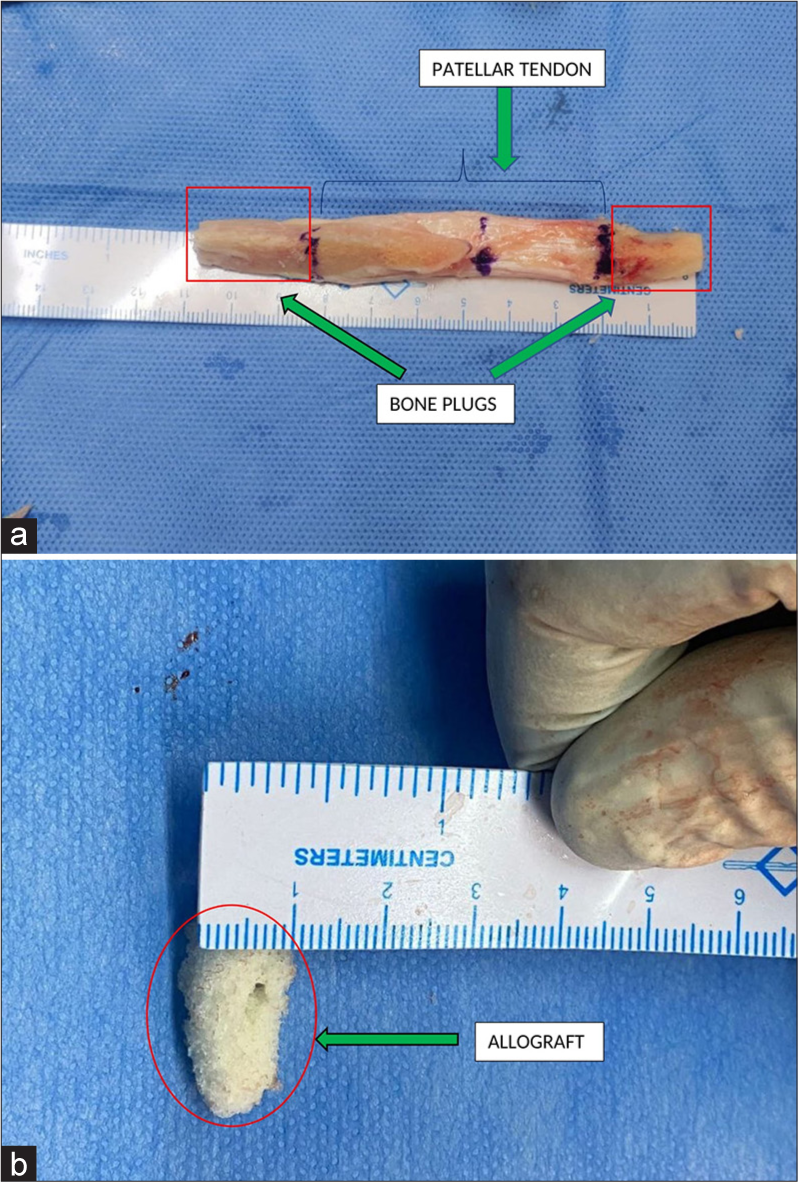 (a) Showing the (green arrow) bone patellar tendon bone graft measuring 110 mm in length and width of 10 mm. (b) Showing the (green arrow) allograft used for the sandwich technique.