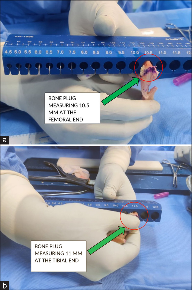 (a) (green arrow) Bone patellar tendon bone graft measurement of femoral end – 10.5 mm. (b) (green arrow) Bone patellar tendon bone graft measurement of tibial end – 11 mm.