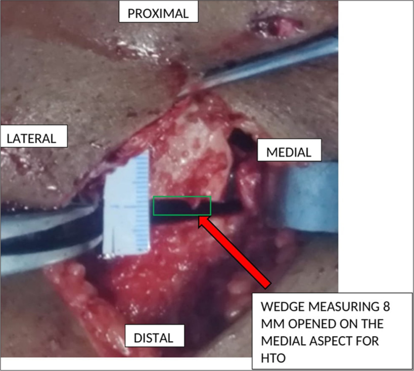 Showing (red arrow) medial opening wedge osteotomy, correction done according to Miniaci’s method as calculated above.