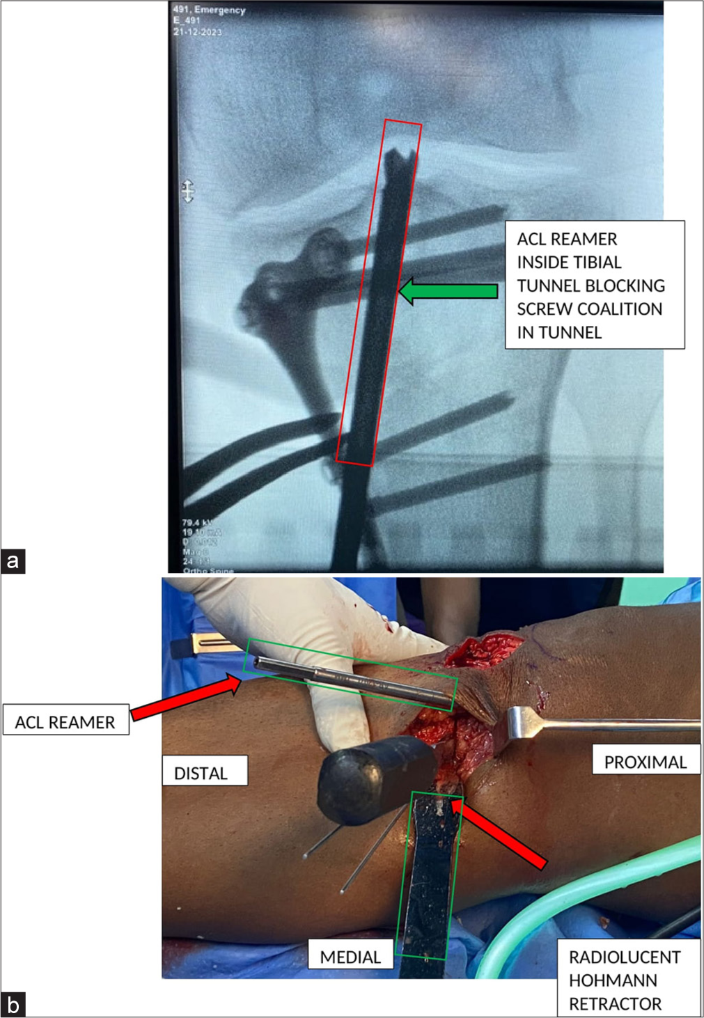 (a) Showing an intra-operative C arm image demonstrating occlusion of tibial tunnel by placing a (green arrow) 8 mm drill in situ to avoid passage of screws into the tibial tunnel. (b) Showing an intra-operative end on image demonstrating occlusion of tibial tunnel by placing a (red arrow) 8 mm drill in situ to avoid passage of screws into the tibial tunnel.