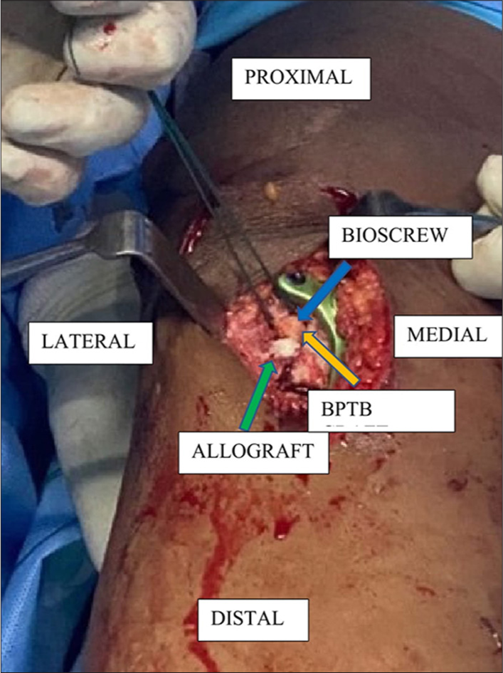 Demonstration of sandwich technique in sagittal section where the tibial end of (orange arrow) bone patellar tendon bone (BPTB) graft is getting sandwiched between the (green arrow) allograft on the one side and (blue arrow) bioscrew on the other side.