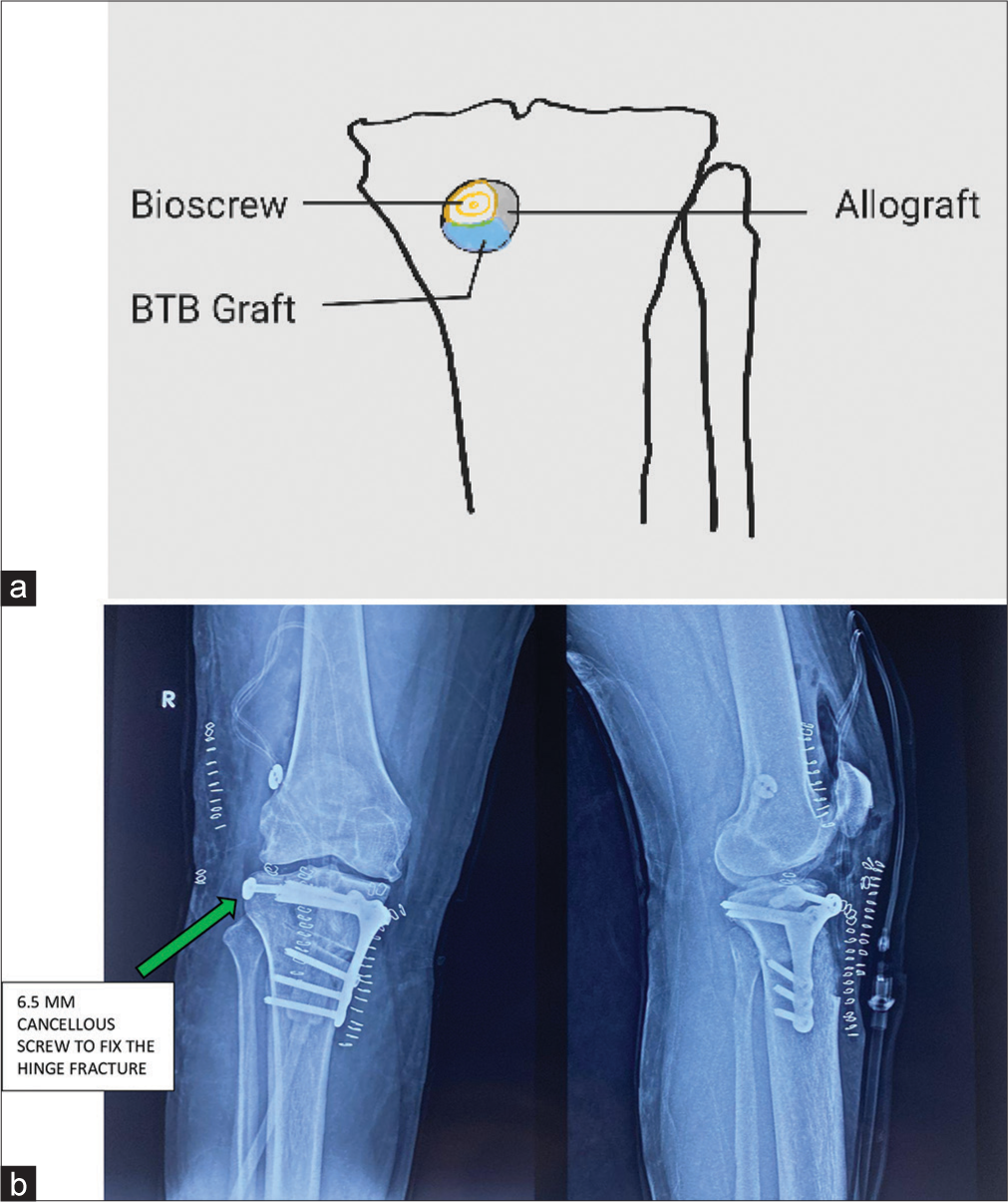 (a) Pictorial demonstration of sandwich technique in coronal section. (b) Shows immediate post-operative X-ray showing medial wedge high-tibial osteotomy and (green arrow) lateral cancellous screw to fix the hinge fracture.