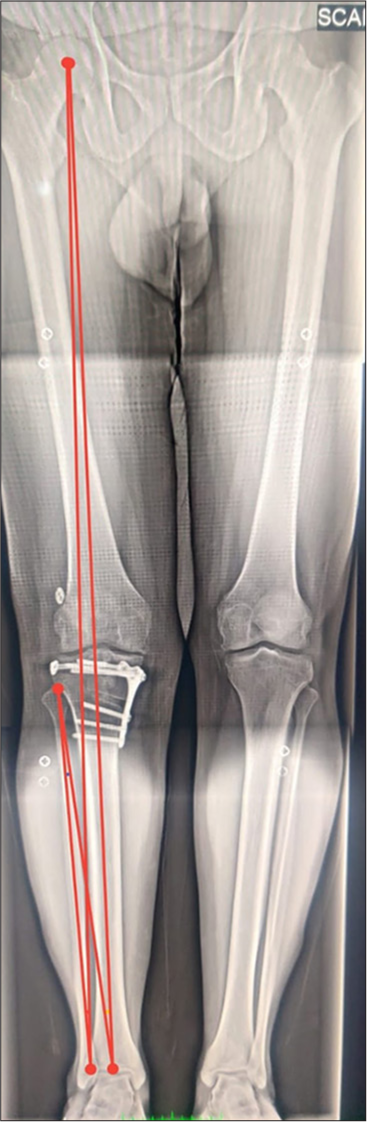 Standing scanogram at 3-month follow-up shows neutral alignment. Red line from the center of the femoral head to the mid-point of the ankle (mechanical axis) passes just lateral to the mid point of the knee as planned (pre-op varus corrected).