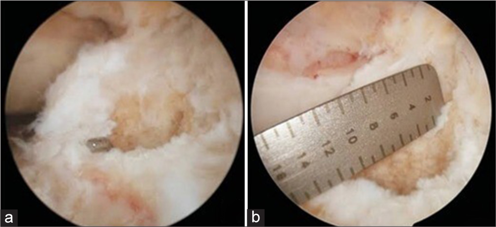 (a) The anteroposterior diameter of the tibial footprint of the anterior cruciate ligament is measured using (b) an arthroscopic ruler.