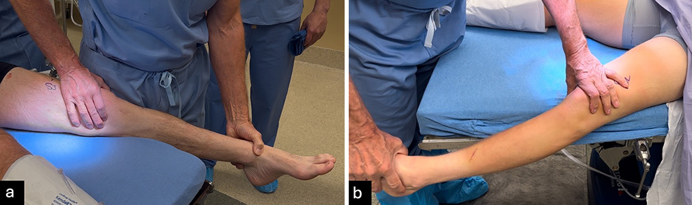 (a) The valgus stress test evaluates the integrity of the medial collateral ligament and supporting posteromedial structures, while (b) the varus stress test assesses the fibular collateral ligament and posterolateral corner. Both assessments are performed with the patient lying supine, and the distal thigh stabilized. For the valgus test, the medial joint line is palpated as a valgus force is applied to the foot or ankle. Similarly, the varus test involves palpating the lateral joint line while applying a varus force. Each test is conducted with the knee positioned in 20-30° flexion and full extension to evaluate for potential ligamentous or cruciate injuries. A positive result is indicated by increased joint laxity or the absence of a firm endpoint when compared to the uninjured contralateral knee.