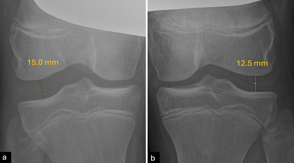 Varus stress radiographs at 20° of knee flexion are an effective diagnostic tool for assessing valgus gapping related to fibular collateral ligament (FCL) or posterolateral corner (PLC) injuries. A side-to-side difference (SSD) in varus gapping between 2.2 mm and 4 mm typically indicates an isolated grade III (complete) tear of the FCL, while an SSD greater than 4 mm is consistent with a complete PLC injury. In the current case, joint gapping of (a) 15 mm on the right knee minus (b) 12.5 mm on the left knee results in a SSD of 2.5 mm suggesting an isolated high-grade FCL of the right knee tear without significant involvement of the PLC.
