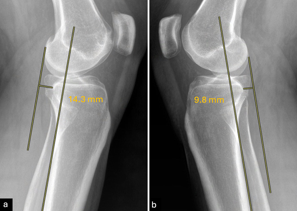Bilateral stress radiographs at 20° of knee flexion are used to evaluate anterior cruciate ligament (ACL) integrity. Parallel lines are drawn along the posterior edge of the tibial diaphysis and the lateral femoral condyle. A side-to-side difference (SSD) in anterior tibial translation (ATT) >3 mm indicates an ACL rupture. In this case, ATT of (a) 14.3 mm on the left knee minus ATT of (b) 9.8 on the right knee results in an SSD of 4.5 mm confirming the presence of an ACL tear of the left knee.