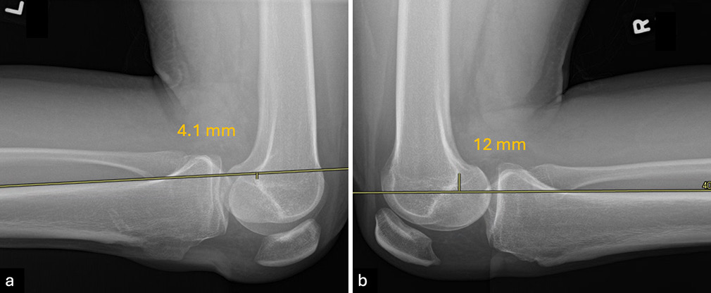 Lateral kneeling posterior stress radiographs are used to evaluate posterior cruciate ligament (PCL) laxity by measuring posterior tibial translation (PTT) in both knees. The patient kneels with the proximal tibial joint line positioned at the edge of a table or support apparatus. A parallel line is drawn along the posterior tibial cortex, starting at least 15 cm distal to the joint line, and a perpendicular line is extended to the posterior point of the Blumensaat line. The distance measured represents the PTT for each knee, and the side-to-side difference (SSD) quantifies the extent of translation. An SSD of 0-8 mm suggests a partial PCL tear, 8-11 mm indicates a complete tear, and >12 mm suggests combined injuries. In this case, the (a) left knee has a PTT of 4.1 mm while the (b) right knee has a PTT of 12 mm, adding these together results in a SSD of 16.1 mm consistent with a full PCL tear with potential combined injuries.
