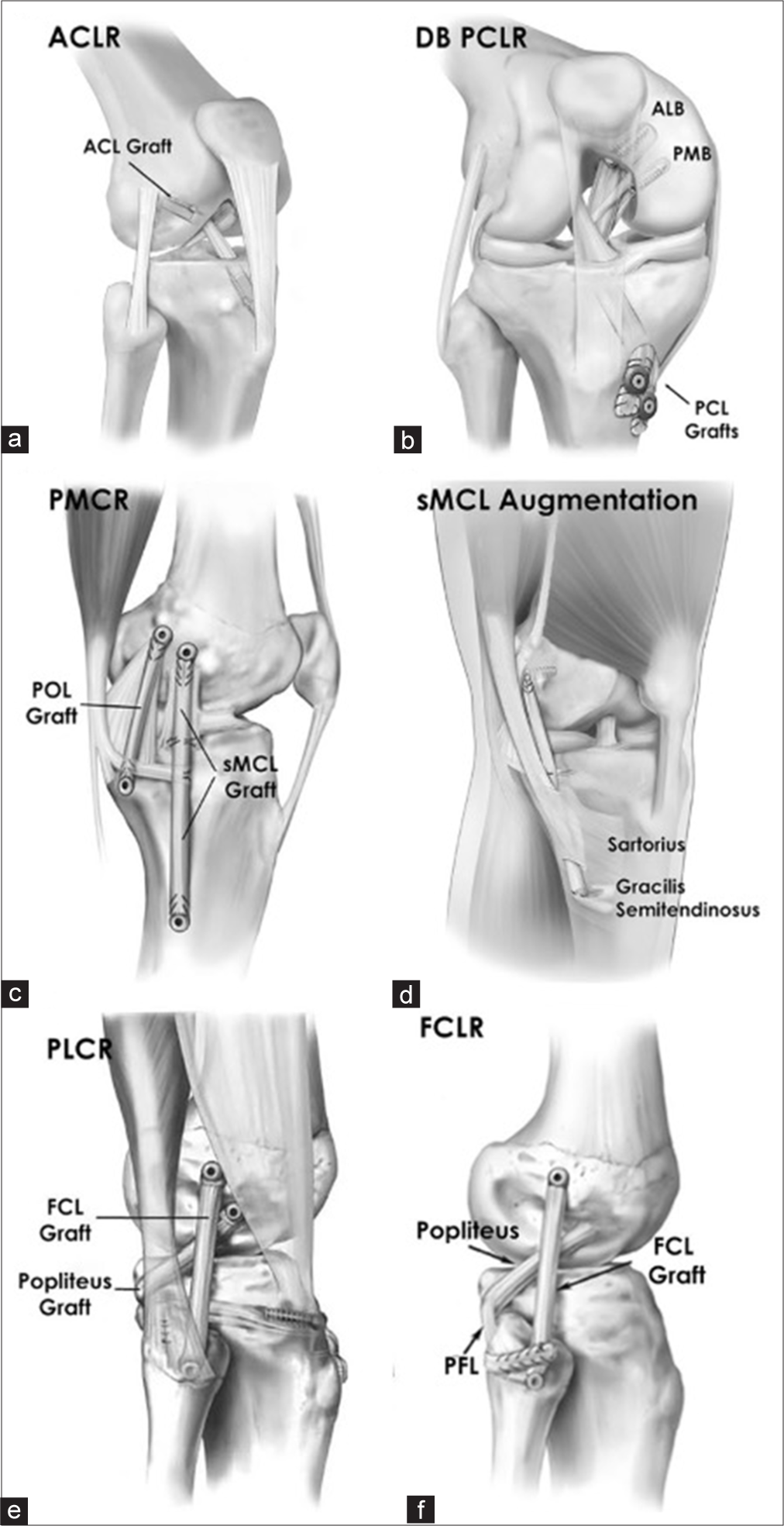 Examples of reconstruction techniques of the four major knee ligament complexes in a multiligament knee injury. (a) Anterior cruciate ligament reconstruction (ACLR), (b) double bundle posterior cruciate ligament reconstruction (DB-PCLR), (c and d) posteromedial complex reconstruction (PMCR), superficial medial collateral ligament (PMCR), (e) posterolateral corner reconstruction (PLCR), (f) fibular collateral ligament reconstruction (FCLR). ACL: Anterior cruciate ligament, PCL: Posterior cruciate ligament, ALB: Anterolateral bundle, PMB: Posteromedial bundle, POL: Posterior oblique ligament, FCL: Fibular collateral ligament, PFL: Popliteofibular ligament. (Reprinted from LaPrade et al., 2019, with permission).[67]