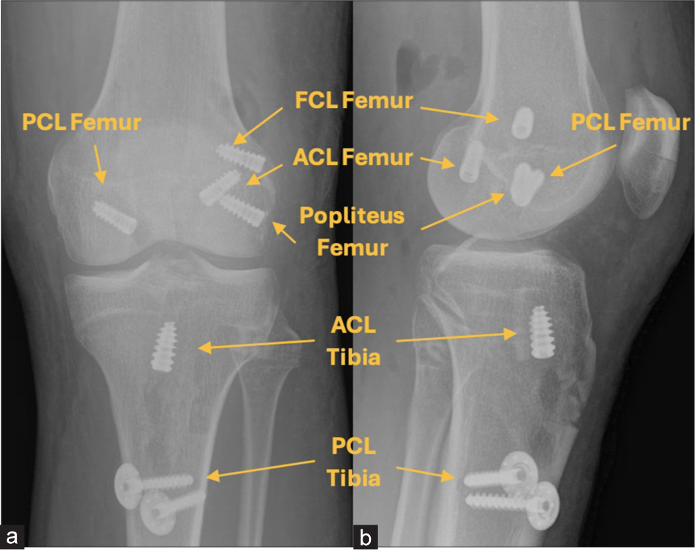 (a) Anteroposterior and (b) lateral postoperative radiographs illustrating the reconstruction of the anterior cruciate ligament (ACL), posterior cruciate ligament (PCL), fibular collateral ligament, popliteus tendon, and popliteofibular ligament. The ACL graft is secured with titanium screws at both the femoral and tibial attachments. Additional titanium screws anchor the anterolateral PCL bundle, fibular collateral ligament (FCL), and popliteus tendon at the femur. A post and spike washer are used to stabilize the anterolateral and posterolateral PCL bundles at the tibia, while bioabsorbable screws secure the posteromedial PCL bundle and posterolateral corner grafts at the fibular head and tibia (not shown).