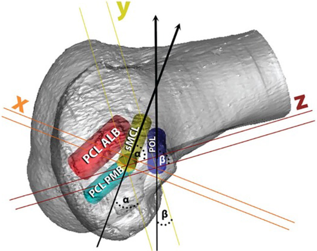 The femoral reconstruction tunnel for the superficial medial collateral ligament (sMCL) should be directed at a 40° angle anteriorly and proximally to avoid interference with the posterior cruciate ligament tunnels. With the patient positioned supine, the surgeon lowers their hand and guides the reamer 40° upward and toward the hip joint. Similarly, the femoral reconstruction tunnel for the posterior oblique ligament is oriented at a 20° angle proximally and anteriorly to prevent overlap with the sMCL tunnel. Angles “α” and “β” represent 40° and 20°, respectively, ensuring precise tunnel placement. The x line represents the x axis (medial to lateral), the z line represents the z axis (proximal to distal), and the y line represents the y axis (anterior to posterior). PCL: Posterior cruciate ligament, ALB: Anterolateral bundle, PMB: Posteromedial bundle, POL: Posterior oblique ligament. (Reprinted from Moatshe et al., 2016, with permission).[69]