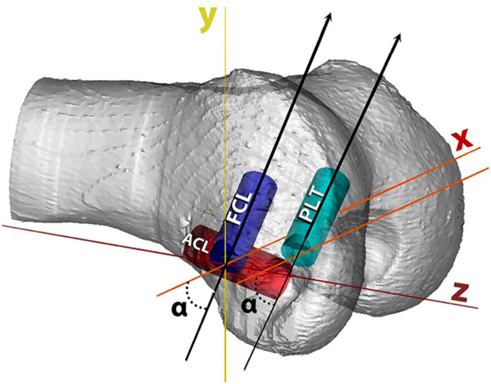 To avoid convergence with the anterior cruciate ligament tunnel, the fibular collateral ligament (FCL) tunnel should be angled 35° anteriorly. This alignment is achieved by lowering the surgeon’s hand and directing the reamer upward while the patient is in a supine position. The popliteus tendon tunnel is positioned parallel to the FCL tunnel, also at a 35° angle, to ensure it does not breach the intercondylar notch. The angle “α” represents 35° forward from the horizontal plane (x-axis), ensuring accurate and non-interfering tunnel placement. The x line represents the x axis (medial to lateral), the z line represents the z axis (proximal to distal), and the y line represents the y axis (anterior to posterior). PLT: Popliteus tendon, ACL: Anterior cruciate ligament. (Reprinted from Moatshe et al. 2016, with permission).[69]