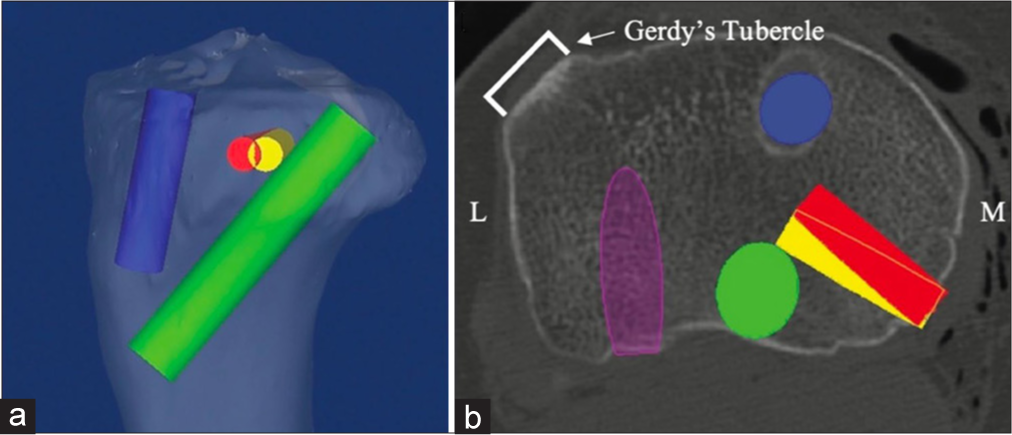 To prevent convergence between the posterior oblique ligament (POL) tunnel and the posterior cruciate ligament (PCL) tunnel (marked in green), the POL tunnel should be positioned 15 mm medial to Gerdy’s tubercle (highlighted in red) along the horizontal plane. Aiming directly at Gerdy’s tubercle (indicated in yellow) increases the likelihood of intersecting with the PCL tunnel. The anterior cruciate ligament tunnel is represented in blue, while the posterolateral corner tunnel is shown in purple. (a) A lateral view illustrates the POL tunnel exit, and (b) an axial view demonstrates the correct trajectory for the POL tunnel. L indicates lateral, and M indicates medial (Reprinted from Moatshe et al. 2016, with permission).[69]