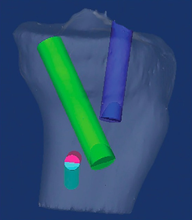 A three-dimensional model demonstrates the spatial relationship between the superficial medial collateral ligament (sMCL) tunnel (pink) and the posterior cruciate ligament tunnel (green). When the sMCL tunnel is positioned anterior to the fibular shaft in the horizontal plane, the two tunnels are in close proximity. To avoid convergence, the sMCL tunnel should be oriented transversely across the tibia, positioned ahead of the fibula, and angled 30° distally (light blue). The anterior cruciate ligament tunnel is shown in dark blue for reference (Reprinted from Moatshe et al. 2016, with permission).[69]