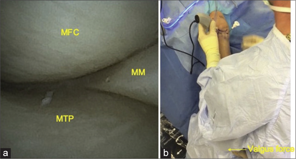 (a) The medial compartment of the knee - Medial femoral condyle (MFC), medial tibial plateau (MTP) and medial meniscus (MM). (b) External picture - Needle arthrosocope in the central portal and cannula in the medial portal. Reproduced from Quinn et al. Copyright © The Author(s). 2020, Open Access. This article is distributed under the terms of the Creative Commons Attribution 4.0 International License (http://creativecommons.org/licenses/by/4.0/).