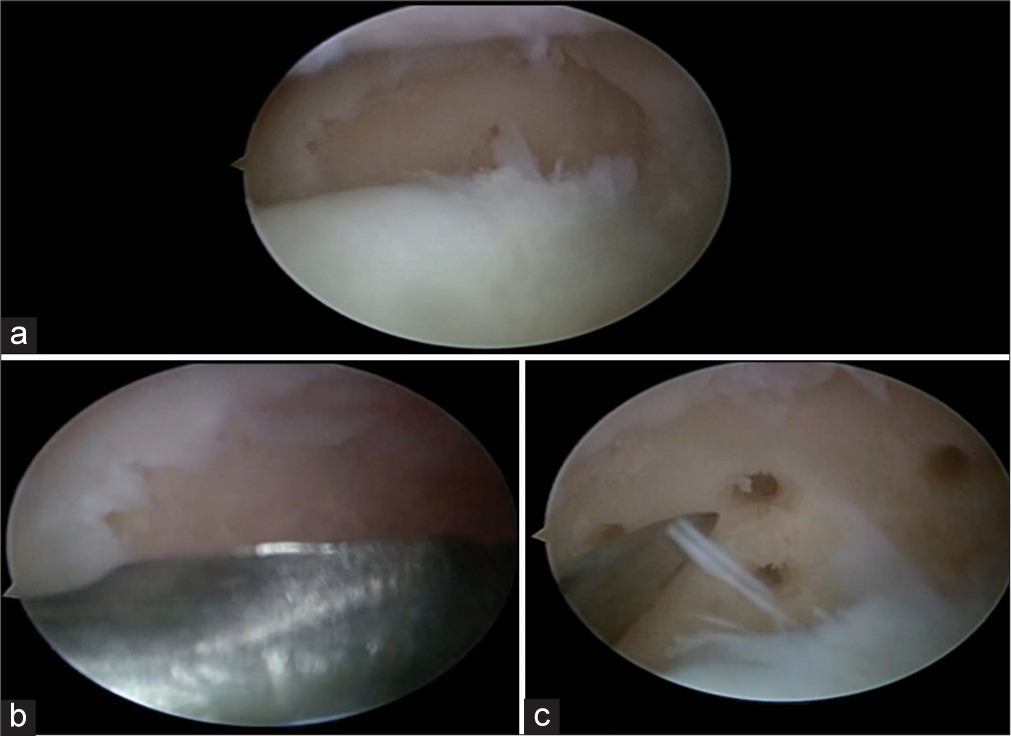 (a) Arthroscopic image of an osteochondral fragment of the medial femoral condyle seen separated from its bed, (b) arthroscopic image showing the bed of the fragment being curetted, and (c) arthroscopic image showing microfractures being done in the bed of the fragment on the medial femoral condyle.