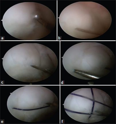 (a) Arthroscopic image showing the fragment reduced to its anatomical location with a probe, (b) arthroscopic image showing the osteochondral fragment temporarily fixed to its bed with a ‘K’ wire, (c) arthroscopic image showing a beath pin carrying one end of a No. 1 Vicryl drilled through the medial femoral condyle at 3 o’ clock position to the fragment, (d) arthroscopic image showing a beath pin carrying the other end of a No. 1 Vicryl drilled through the medial femoral condyle at 9 o’; clock position to the fragment, (e) arthroscopic image showing a No. 1 Vicryl encircling the osteochondral fragment and compressing it to its bed, and (f) arthroscopic image showing multiple No. 1 Vicryl sutures stabilizing the fragment.