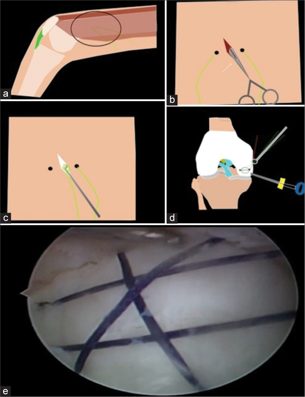 (a) Illustration of No. 1 Vicryl sutures exiting through the medial aspect of the thigh (black circle), (b) illustration showing a linear incision made between the two ends of the same suture, (c) illustration showing a probe delivering the two ends of the suture through the wound, (d) illustration showing a knot pusher tying two ends of the suture on the medial femoral cortex to stabilize the fragment, and (e) arthroscopic image showing the stabilized fragment with multiple No. 1 Vicryl sutures.