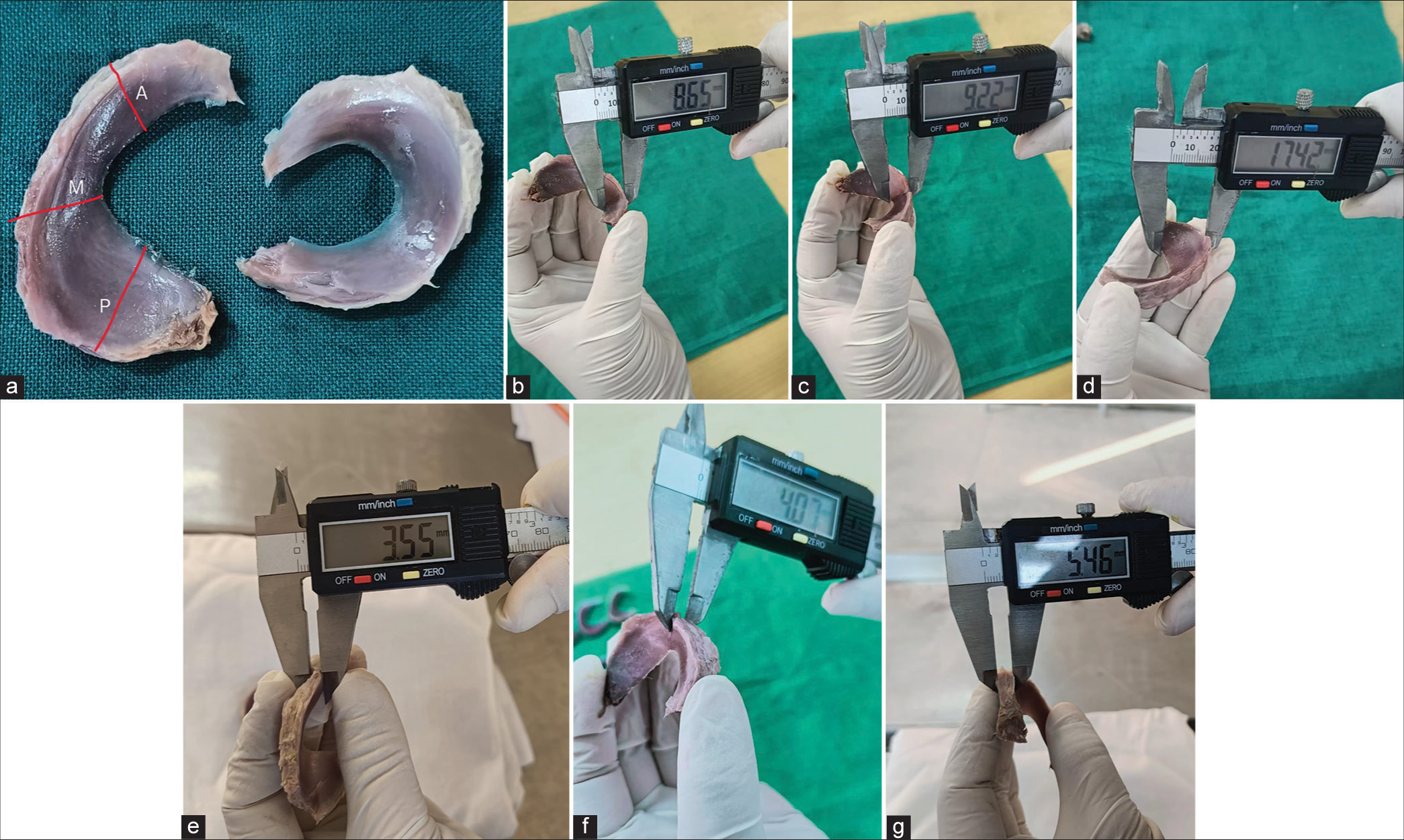 (a) Picture representing the three points of morphometric analysis of menisci in the Anterior (A), Middle (M), and Posterior (P) thirds of a meniscus. (b) Meniscal width measurement at anterior 1/3 using digital vernier caliper. (c) Meniscal width measurement at middle 1/3 using digital vernier caliper. (d) Meniscal width measurement at posterior 1/3 using digital vernier caliper. (e) Meniscal thickness measurement at anterior 1/3 using digital vernier caliper. (f) Meniscal thickness measurement at middle 1/3 using digital vernier caliper. (g) Meniscal thickness measurement at posterior 1/3 using digital vernier caliper.