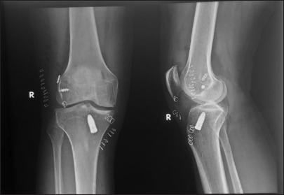 Post-operative right knee X-ray antero-posterior view of the patient showing post-anterior cruciate ligament reconstruction with lateral extra-articular tenodesis.