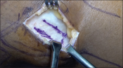 From the lateral view on the left knee, the procedure is begun with a posterolateral hockey stick incision on the left knee and exposure of the iliotibial band is performed before harvest of the graft.