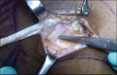 From the lateral view on the left knee, the fibular collateral ligament has been identified and the iliotibial band graft should be passed beneath it.