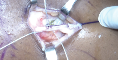 From the lateral view on the left knee, proximal fixation of the iliotibial band graft is performed with a 2.8 mm double-loaded all-suture anchor with knee kept in neutral rotation and flexed to 20 and tension pulled on the graft, completing the lateral extra-articular tenodesis procedure.