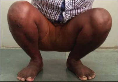 Post-operative photograph of the athlete showing his ability to squat fully.