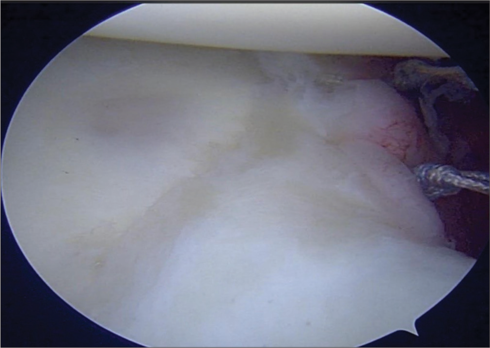 Image showing posterior-superior labral repair.