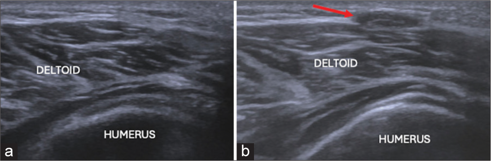 (a) Short axis ultrasound image and (b) on stressing showing herniation of deltoid through fascial defect (red arrow).