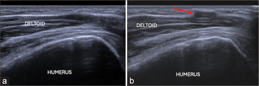 (a) Longitudinal ultrasound image and (b) on stressing showing herniation of deltoid through fascial defect (red arrow).