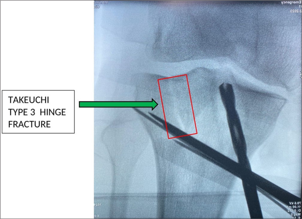 Showing an intra-operative C arm image demonstrating a Type 3 Takeuchi lateral hinge fracture (green arrow).