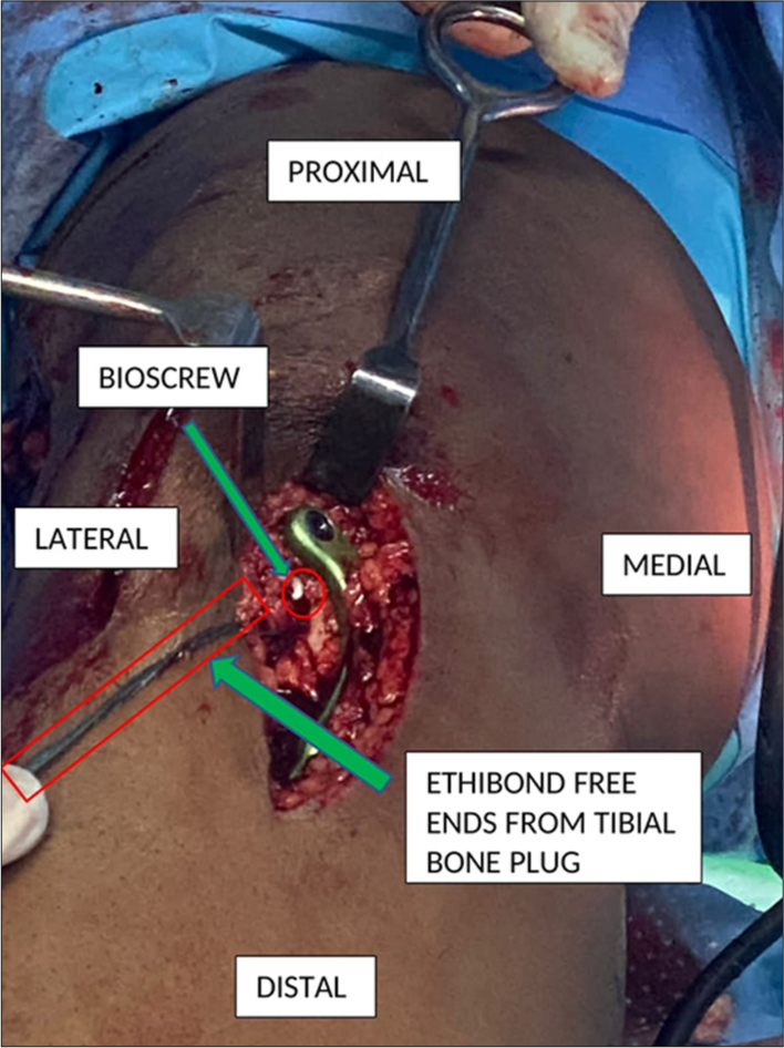 The “Sandwich” technique where the tibial end of bone patellar tendon bone graft is getting sandwiched between the allograft on the one side and bioscrew on the other side (green arrows).